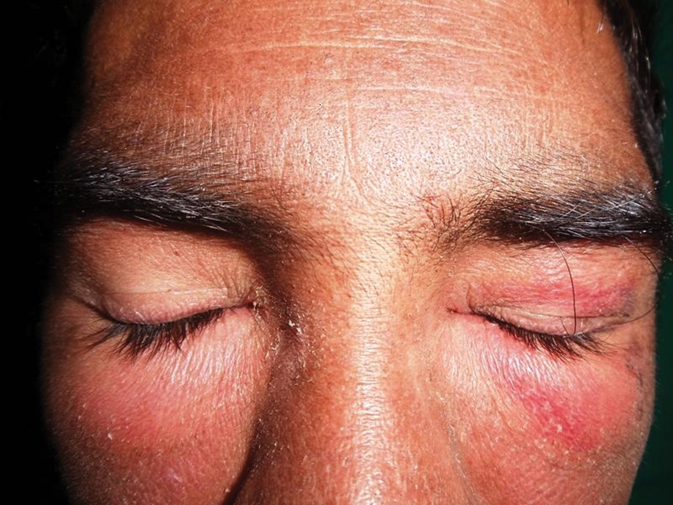 2013.25.Cutaneous Our Dermatology Online